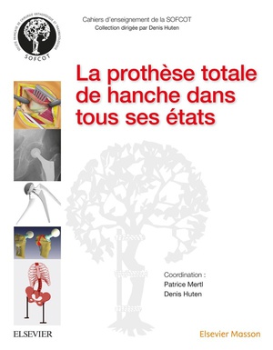 La prothèse totale de hanche dans tous ses états - 9782294751165