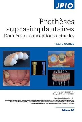 Prothèses supra-implantaires - 9782843614026